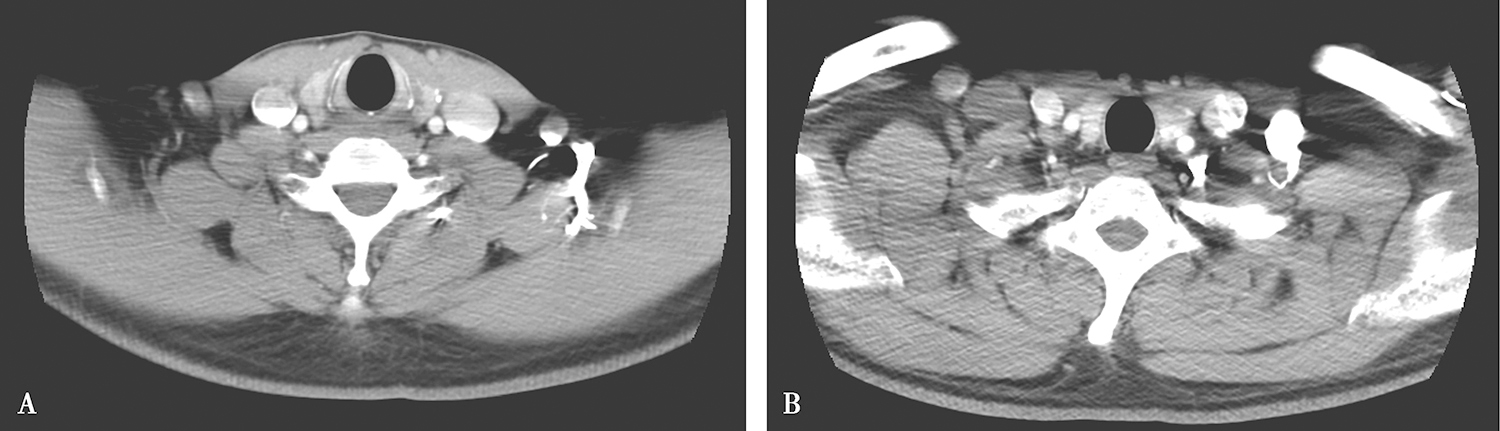 图2 颈部增强CT